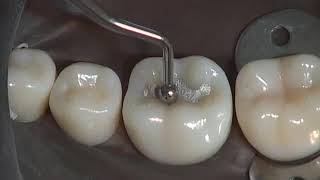 Class I Amalgam Preparation amp Restoration  Operative Dentistry [upl. by Meta]