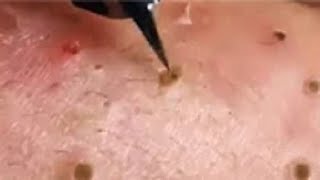 Full Giant Blackheads Popping Video Blackheads Removal 2019 [upl. by Ynohtn544]