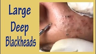 Large Deep Blackheads Large Blackheads Extraction Best Pimple PoppingBlackheads Removal [upl. by Quirita]