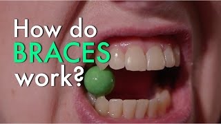 How Do Braces Work [upl. by Led]