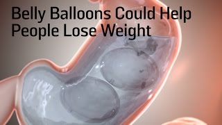 Bariatrics patient opts for gastric balloon to help lose weight [upl. by Dleifrag]