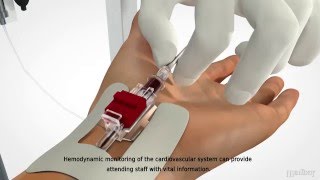 MEDBAR  Arterial Cannula [upl. by Notlih]