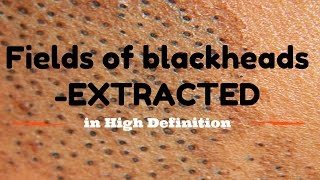 Blackhead fields extractions in HD [upl. by Whalen]