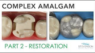 Complex Amalgam Restoration  Part 2 [upl. by Anaitsirc24]