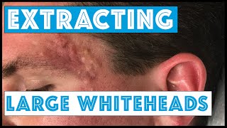 Acne Vulgaris and Extracting large Whiteheads  Part 1 [upl. by Leahcimnoj895]