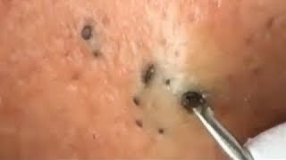 CYST POP AND HUGE BLACKHEAD Removal Videos 2020 [upl. by Nonohcle]