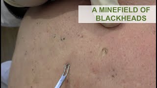 A Minefield of Blackheads  Dr Derm [upl. by Sevein55]