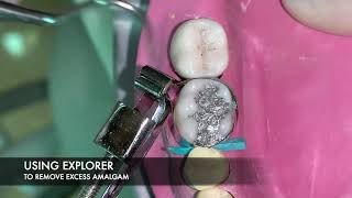 Class II Amalgam Restoration [upl. by Samala]