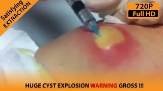 Removing a Very Huge Cyst From Lower Back WARNING GROSS   Satisfying Extractions [upl. by Saw]