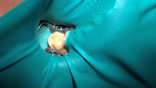 How To Do IAOMT Amalgam Filling Removal [upl. by Gunas]