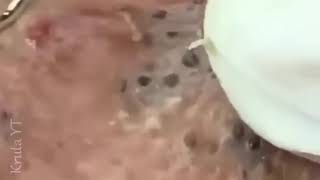 Cystic Acne Extraction This WeekBlackheads RemovalBlackhead Extractions [upl. by Hadihsar]