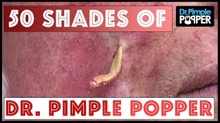 50 shades of DrPimplePopper A 1 Million Subs Special [upl. by Adlih]