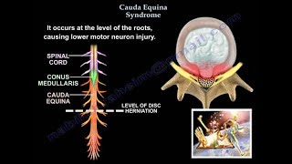 Cauda Equina Syndrome  Everything You Need To Know  Dr Nabil [upl. by Ewart]