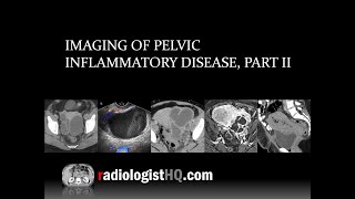 Imaging of Pelvic Inflammatory Disease Part I [upl. by Kcirddehs]