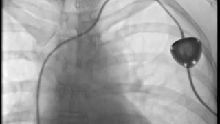 Interventional Radiology  Portacath Device Insertion [upl. by Leandro]