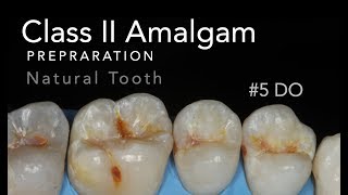 Class II Amalgam Preparation  5 DO Natural Tooth [upl. by Llewon]