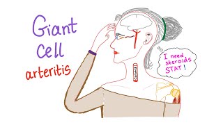 Giant cell arteritis Temporal arteritis [upl. by Eugenia145]