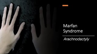 Marfan Syndrome Wrist and Thumb Sign [upl. by Nebur]