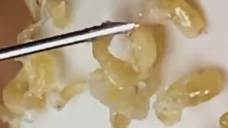 Deep blackhead extraction Cystic acne amp pimple popping 26 [upl. by Sonafets76]