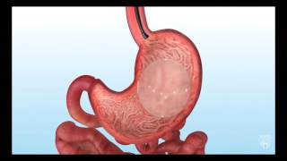 Mayo Clinic Minute  Intragastric Balloon for Weight Loss [upl. by Goff370]