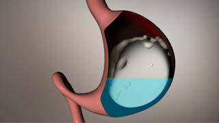 Staceys placement of the Elipse™ Gastric Balloon [upl. by Velick833]