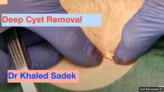 Deep Cyst Removal Dr Khaled Sadek LipomaCystcom [upl. by Errised]