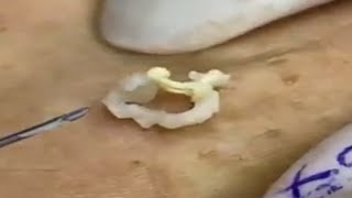 Cyst and blackheads extraction 267  Loan Nguyen [upl. by Fenton]