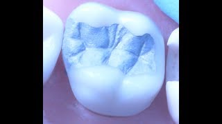 Class II Amalgam Restoration 1  Operative Dentistry [upl. by Terryn787]