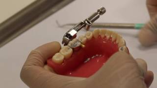 Class II amalgam cavity preparation amp restoration [upl. by Terrej]