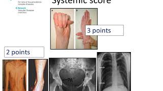 Marfan Syndrome  Diagnosis by Prof Julie De Backer [upl. by Cerell]