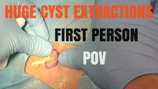 Huge CYST extraction  First Person POV [upl. by Pierce868]