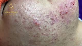 Blackheads Removal 333a  Loan Nguyen [upl. by Nosirb]